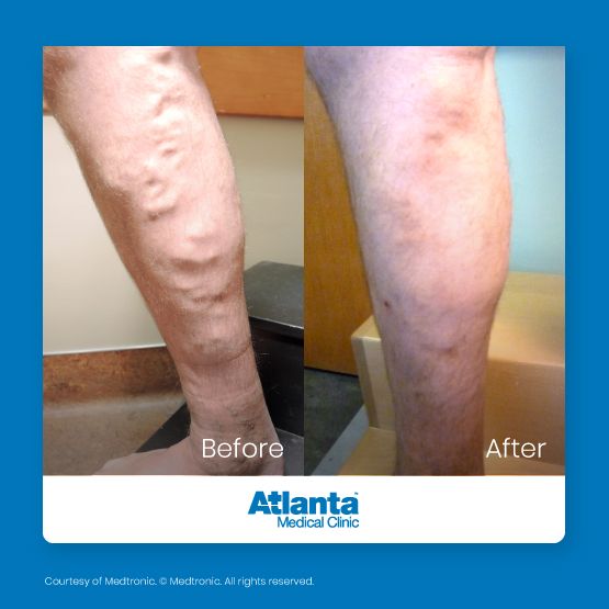 Before and after varicose vein treatment — lower leg, VENCLOSE™ RFA