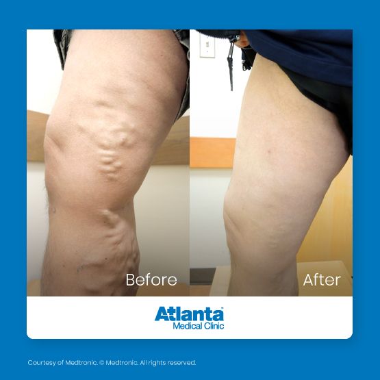 Before and after varicose vein treatment — upper leg, Varithena® treatment