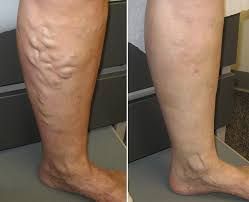 Before and after sclerotherapy treatment – Leonida V.