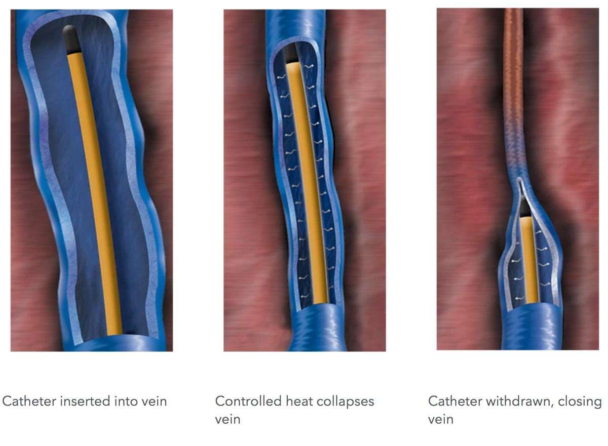 VENCLOSE RFA: The Minimally Invasive Varicose Vein Solution